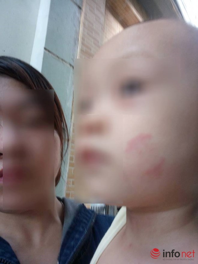 Hà Nội: Bé 20 tháng tuổi bị cắn tím người khi ở trường mầm non về - 2