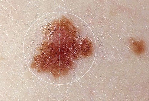 Cảnh báo mối nguy hiểm khi xuất hiện nốt ruồi trên cơ thể - 2