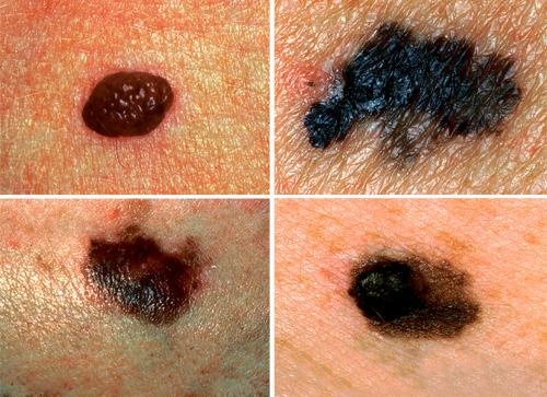 Cảnh báo mối nguy hiểm khi xuất hiện nốt ruồi trên cơ thể - 3