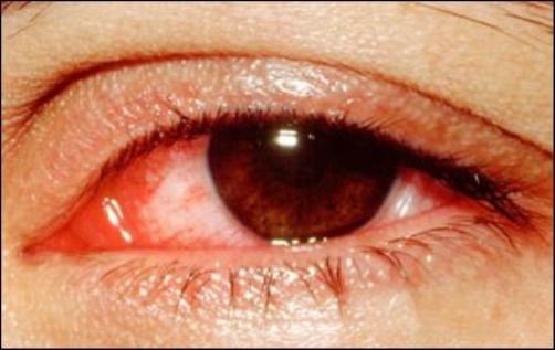 Cảnh báo dịch đau mắt đỏ vào mùa: Cách phòng và chữa bệnh - 1
