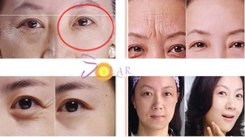 HOT: Ưu đãi 75% dịch vụ xóa nhăn, trẻ hóa da mặt không phẫu thuật - 2