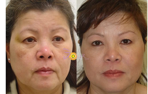 HOT: Ưu đãi 75% dịch vụ xóa nhăn, trẻ hóa da mặt không phẫu thuật - 3