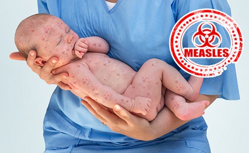 10 căn bệnh tưởng đã biến mất nhưng vẫn đe dọa loài người - 2