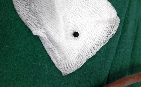 Bé 8 tuổi bị đạn găm vào đùi khi hàng xóm bắn chim - 1