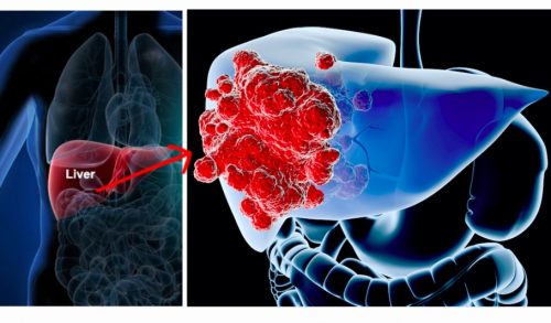 Nhận biết 6 dấu hiệu ung thư gan trước khi quá muộn - 1