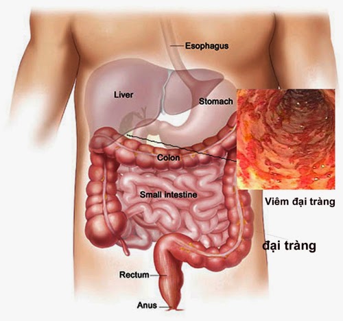 Nếu không muốn ung thư đại trực tràng, hãy ngừng ăn triền miên các món này - 1