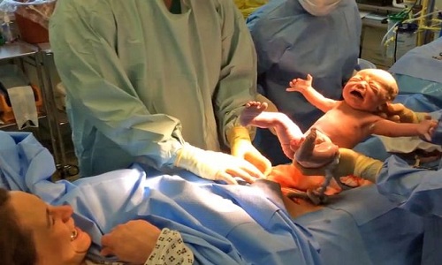 Video: Em bé tự &#34;bật&#34; ra khỏi bụng mẹ bằng sinh mổ tự nhiên - 1