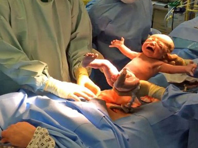 Video: Em bé tự "bật" ra khỏi bụng mẹ bằng sinh mổ tự nhiên
