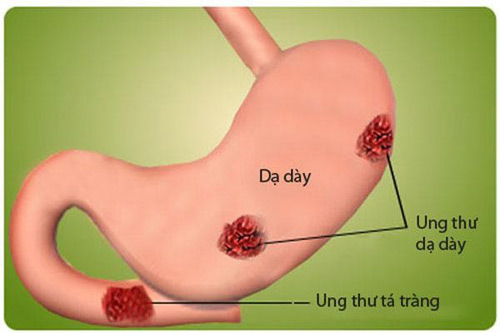 Cảnh báo nguy cơ bệnh viêm loét dạ dày ngày càng tăng cao - 1