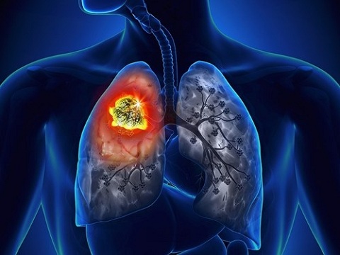 Những dấu hiệu cảnh báo ung thư phổi không thể bỏ qua - 1