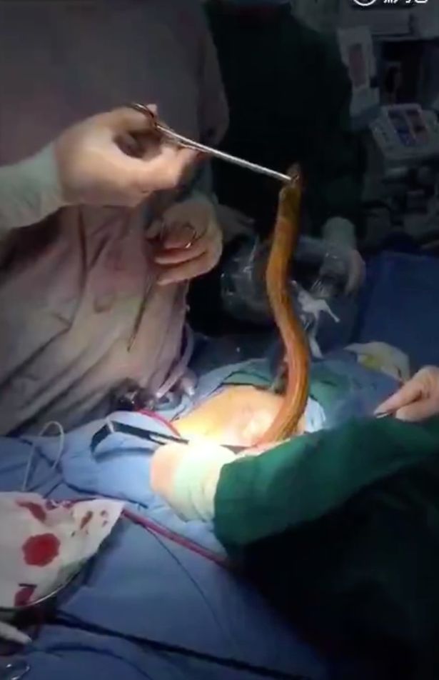 Bác sĩ kéo lươn khổng lồ ra khỏi bụng bệnh nhân - 1