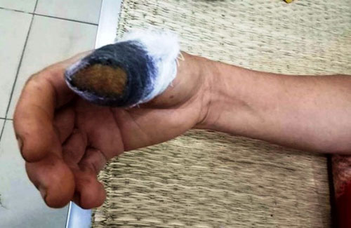 Nóng trong ngày: Rùng mình cắn lìa ngón tay hàng xóm vì nắm mùng tơi - 1