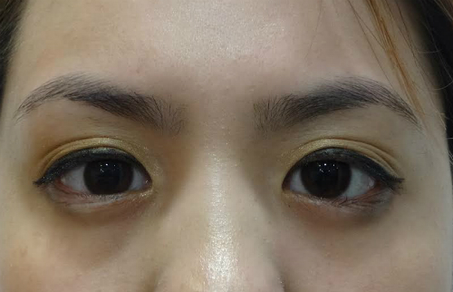 Ca mổ mắt của bác sĩ Việt giúp cô gái Mỹ thoát nguy cơ mù - 2