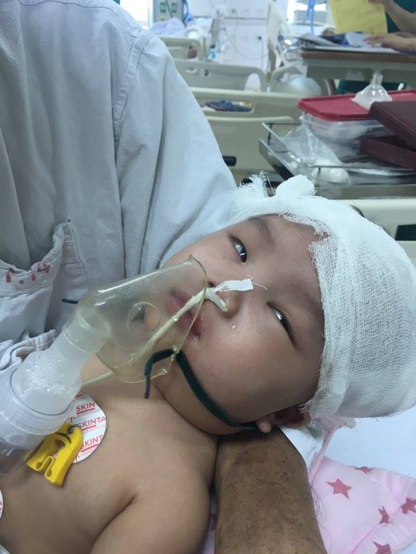 Ngã võng, bé gái 6 tháng tuổi bị chấn thương sọ não nguy kịch - 1
