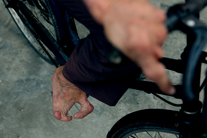 Kì lạ gia đình tay một ngón, chân như chân chim ở Hà Nam - 7