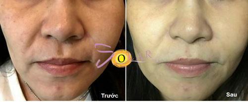 Công nghệ tuyệt vời siêu trắng, xóa nám da chỉ trong 2 giờ - 2