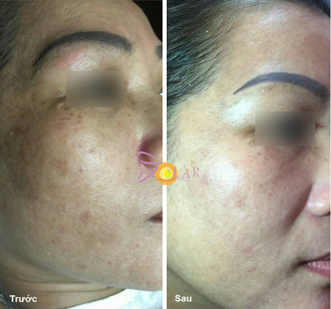 Công nghệ tuyệt vời siêu trắng, xóa nám da chỉ trong 2 giờ - 3