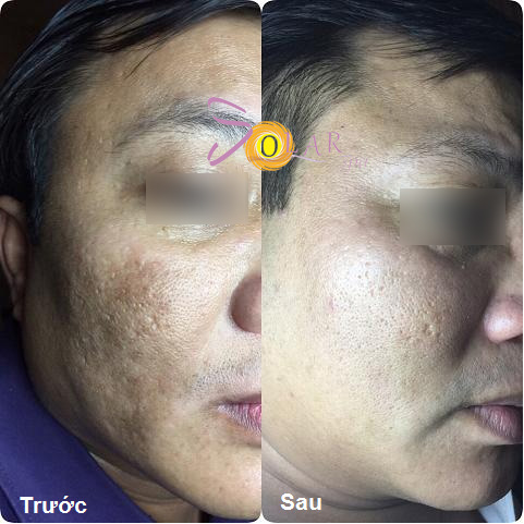 Công nghệ tuyệt vời siêu trắng, xóa nám da chỉ trong 2 giờ - 4