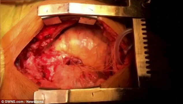 Người đàn ông Ấn Độ có 2 quả tim, 1 nam, 1 nữ - 2