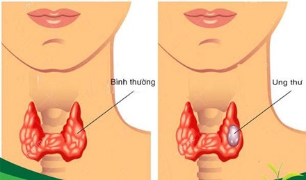 Phát hiện sớm ung thư tuyến giáp nhờ làm xét nghiệm này - 1