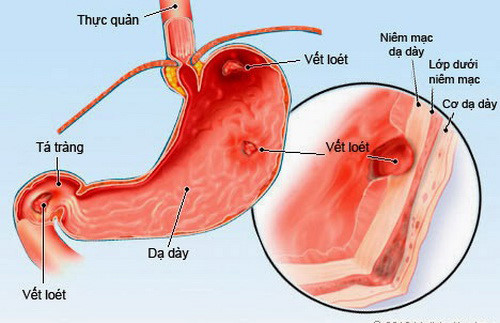 Tưởng con bị giun hoá ra viêm loét dạ dày vì lây vi khuẩn HP từ mẹ - 2