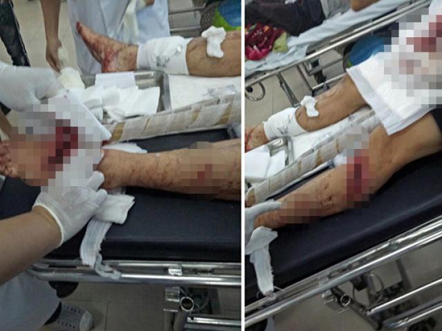 Bênh vợ bị đánh, chồng bị nhóm “giang hồ” chém nhập viện