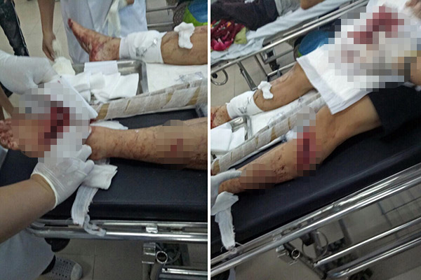 Bênh vợ bị đánh, chồng bị nhóm “giang hồ” chém nhập viện - 1