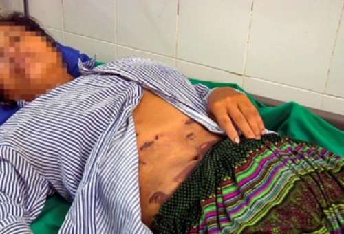 Hi hữu: Suýt mất mạng vì tự ý bôi thuốc bảo vệ thực vật lên người - 1