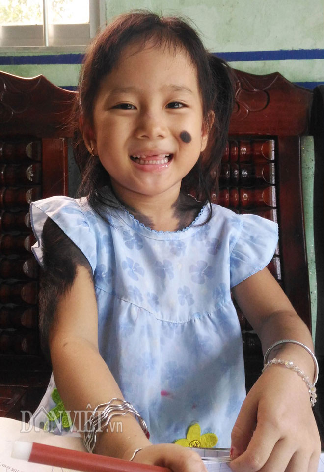 Bé gái 5 tuổi mọc lông đầy mình ở Cà Mau: "Con ngứa và đau lắm" - 4