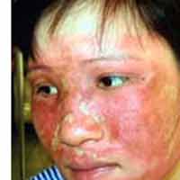 Sức khỏe đời sống - Viêm da nặng do mỹ phẩm