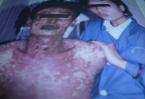 Mù mắt vì thuốc đau đầu - 2