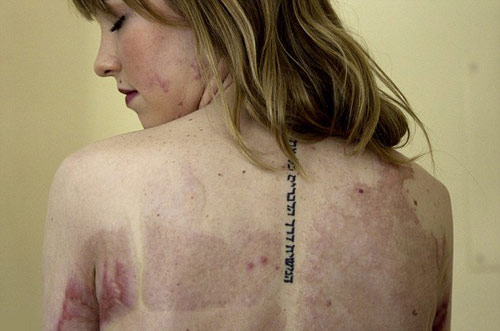 Nơi gặp gỡ của những cô gái bị bỏng mặt - 3