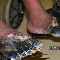 Sức khỏe đời sống - Kinh hoàng đôi chân chết khô, mốc đen