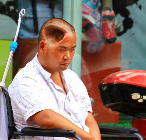 Người đàn ông sống với lỗ hổng trên đầu - 2