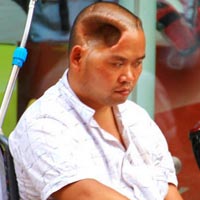 Phi thường - kỳ quặc - Người đàn ông sống với lỗ hổng trên đầu
