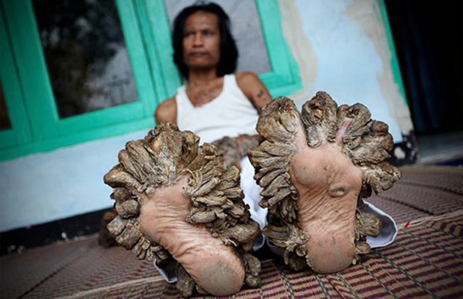 Anh Dede Koswara sống tại ngôi làng Bandung trên đảo Java, Indonesia, bị một chứng bệnh lạ, khiến cơ thể anh mọc đầy “rễ cây” ở khắp tay, chân.