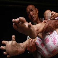 Phi thường - kỳ quặc - Bé 3 tuổi mắc bệnh "chân voi"