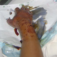 Sức khỏe đời sống - Nguy kịch vì chữa rắn cắn bằng thuốc nam