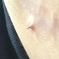 Phi thường - kỳ quặc - Ghim phẫu thuật trong bụng bà bầu