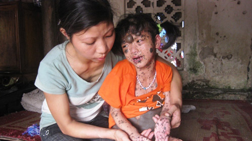 Rớt nước mắt bé gái có hàng nghìn khối u - 1