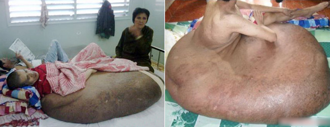 Anh Nguyễn Duy Hải ở Lâm Đồng là người đàn ông chân voi vì khối u đáng sợ ở chân nặng tới 90 kg. Hiện anh đã được phẫu thuật thành công.