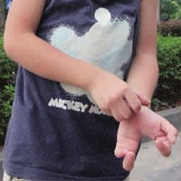 Phi thường - kỳ quặc - Xót xa cậu bé có "bàn tay bướm"