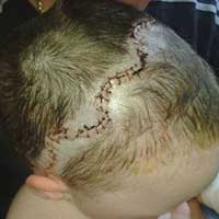 Sức khỏe đời sống - Cậu bé bị bổ đôi hộp sọ sống sót kỳ diệu