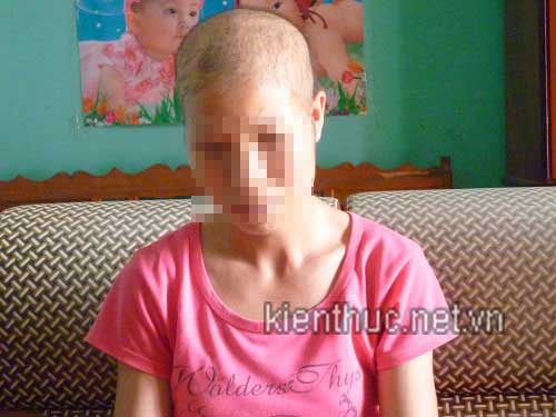 Thối thịt do tiêm thuốc trị hói - 2