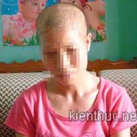 Sức khỏe đời sống - Thối thịt do tiêm thuốc trị hói