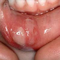 Sức khỏe đời sống - Kinh nghiệm dân gian chữa nhiệt miệng