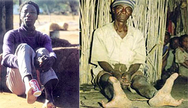 Những người đàn ông ở bộ tộc Doma ở miền Tây Zimbabue hầu như đều có bàn chân với hai ngón rất lớn.
