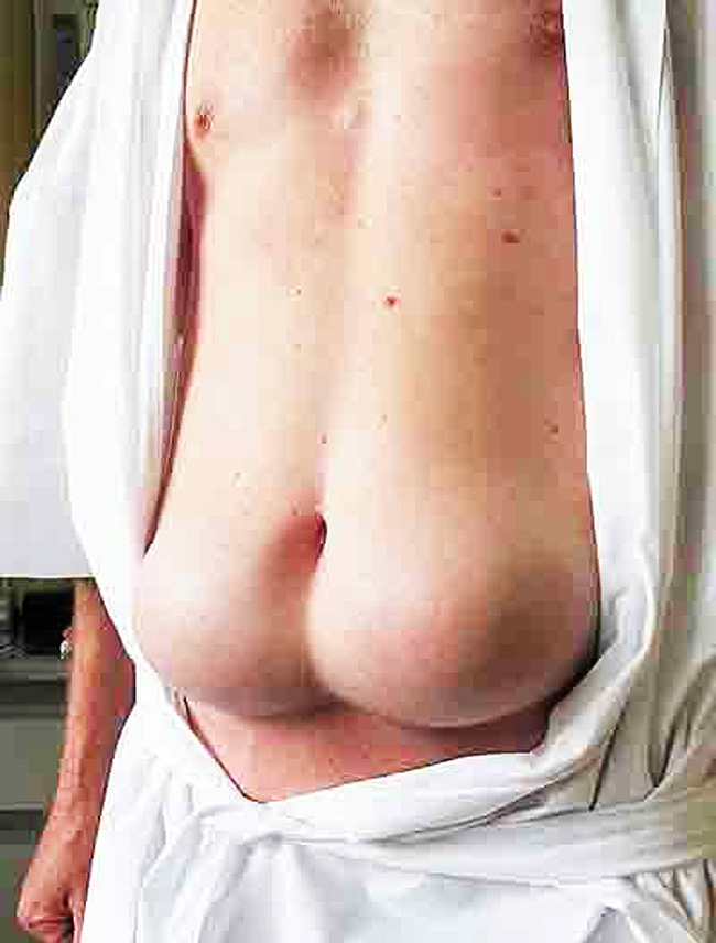 Một người đàn ông 55 tuổi tới từ Nam Phi có hai khối u mỡ căng tròn mọc trên bụng khiến người ngoài nhìn vào ngỡ như một vòng ba dưới rốn.
