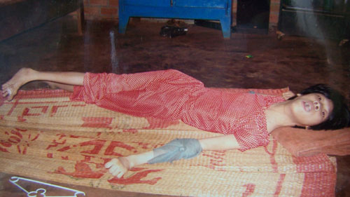 Da cam: Nỗi đau dai dẳng suốt đời - 2