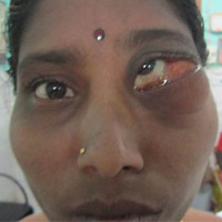 Phi thường - kỳ quặc - Hai chiếc răng "mọc" trong hốc mắt